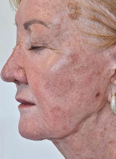 Before - skin before after 7-3