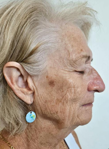 Before - skin before after 15-1