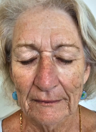 Before - skin before after 15-3