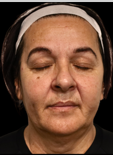 Before - skin before after 5