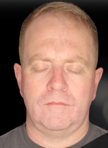 Before - skin before after 6