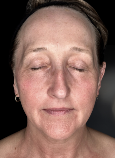 Before - skin before after 7