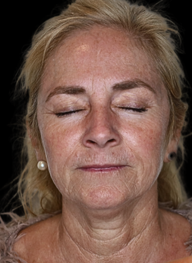 Before - skin before after 8