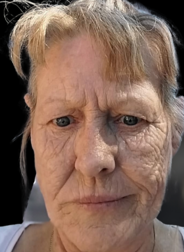 Before - skin before after 9