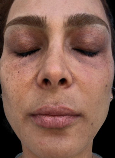 Before - skin before after 10