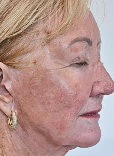 Before - Skin before after-2