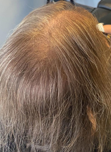 After - Hair growth before after 7