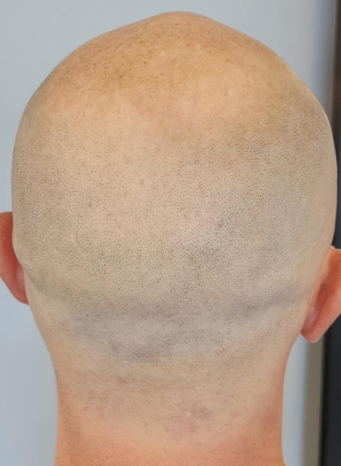 Before - Hair before after 9