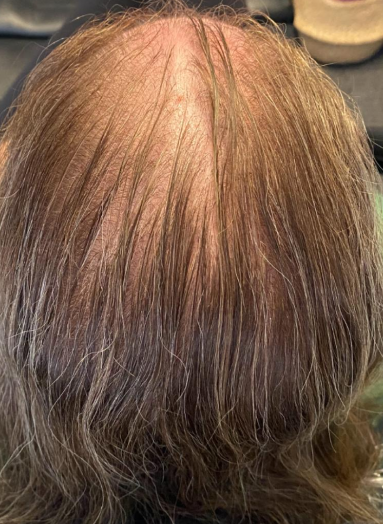 Before - Hair growth before after 7
