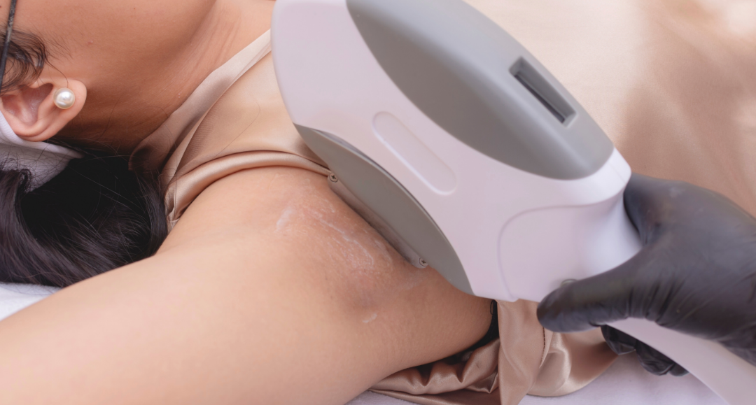 IPL Hair Removal
