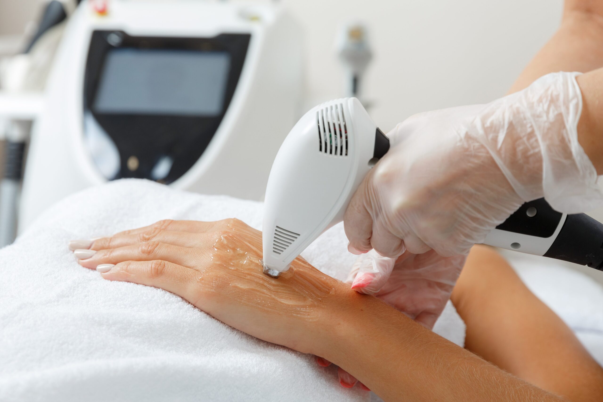 Skin IPL - Frangipani Skin & Body clinic