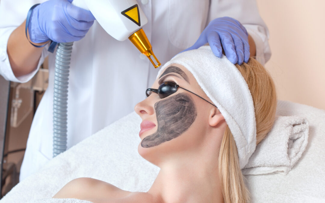 Carbon Laser Facial
