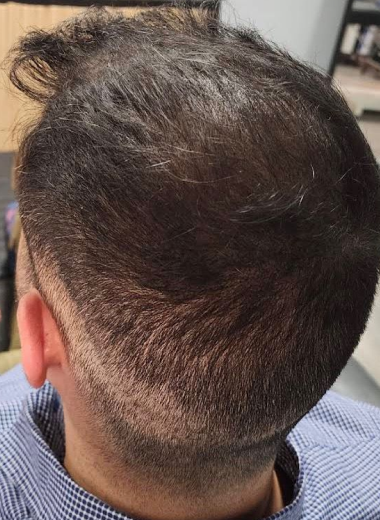 After - Hair regrowth before after 3