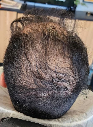 Before - Hair regrowth before after 3
