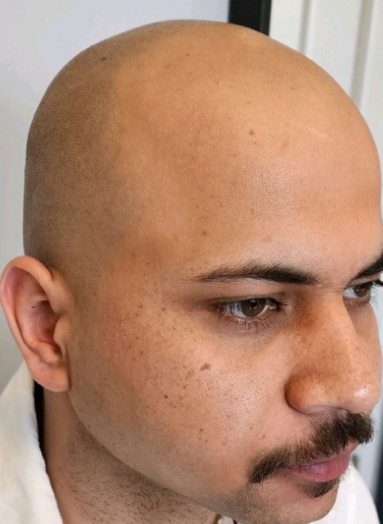 Before - SMP before after 5