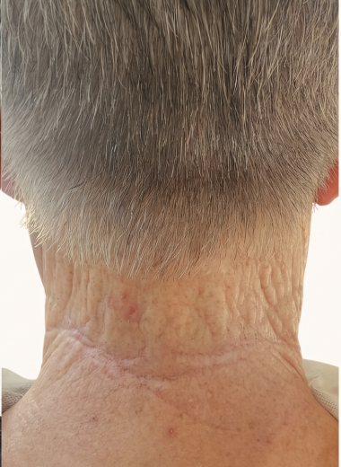 After - skin before after 25