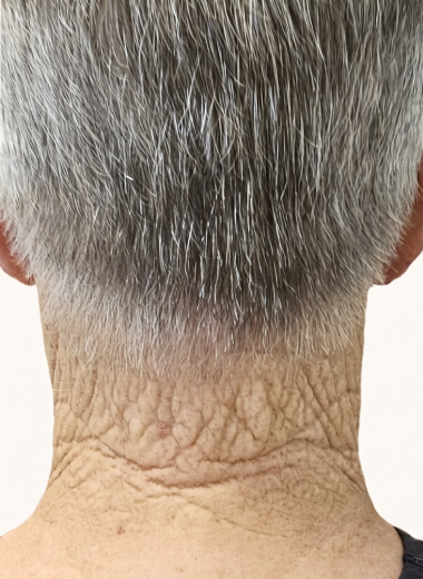 Before - skin before after 25