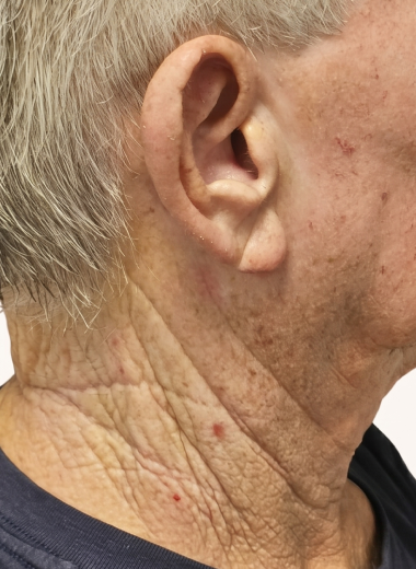 Before - skin before after 26