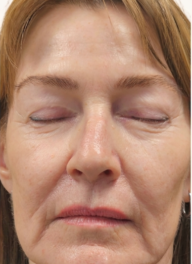 After - skin before after 27