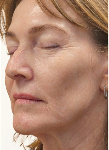 After - skin before after 28