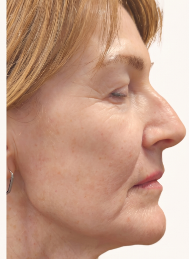 After - skin before after 29