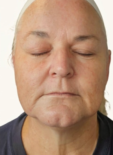 After - skin before after 30