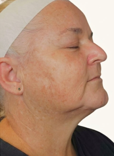 After - skin before after 31