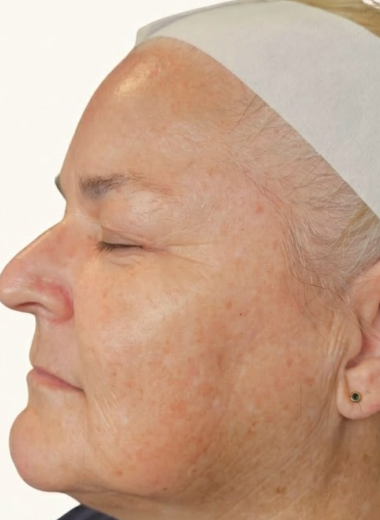 After - skin before after 32