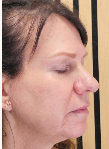 After - skin before after 33