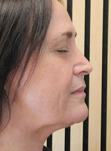 After - skin before after 34