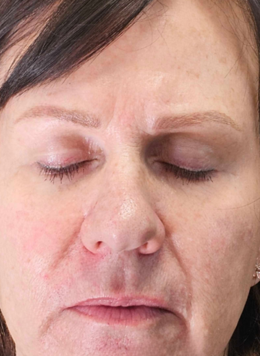 After - skin before after 35