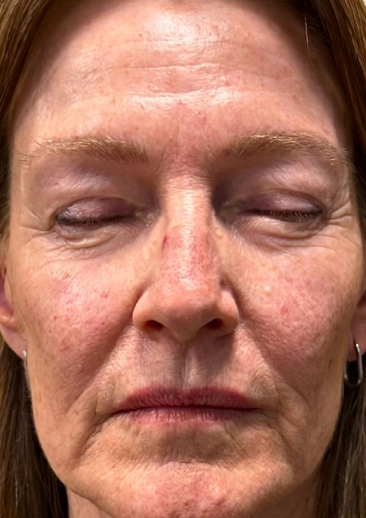 face prior to CO2 laser resurfacing showing sun damage
