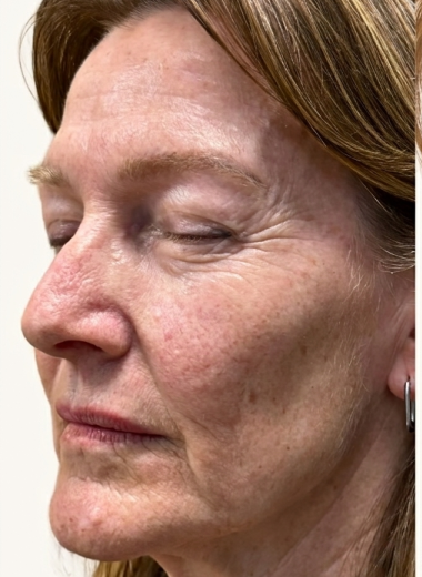 Before - skin before after 28