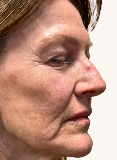 Before - skin before after 29