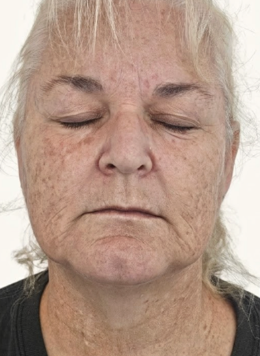 Before - skin before after 30