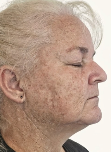 Before - skin before after 31