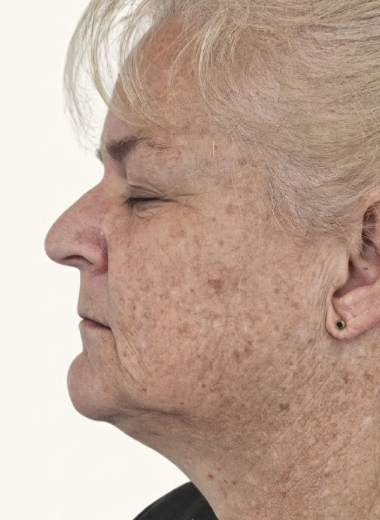 Before - skin before after 32