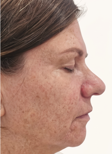 Before - skin before after 33