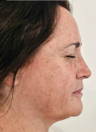 Before - skin before after 34