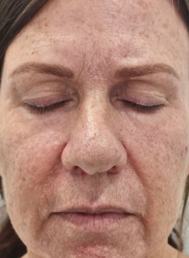 Before - skin before after 35