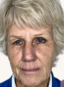 Facial skin prior to CO2 fractional laser resurfacing showing deep wrinkles, fine lines, and uneven skin texture.