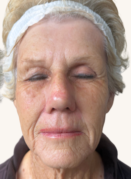 Facial skin after CO2 laser resurfacing showing smoother texture, reduced wrinkle depth, and rejuvenated skin tone.