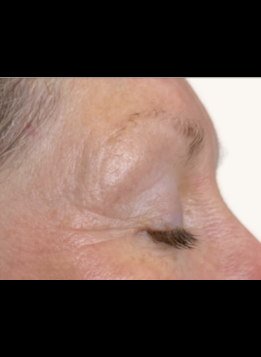 Post-procedure close-up showing visible reduction in periorbital wrinkles, improved skin density, and smoother periorbital tone following fractional CO2 laser skin resurfacing.