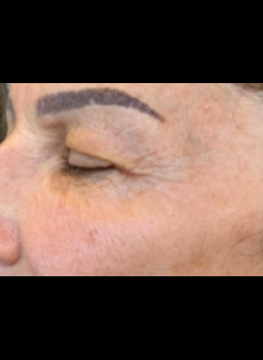 After CO2 laser treatment showing smoother skin and reduced eye wrinkles.
