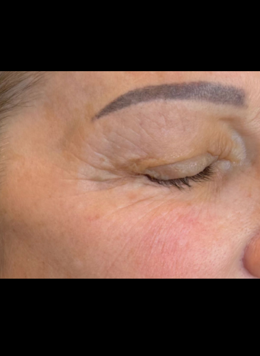After photo demonstrating skin tightening and wrinkle reduction around the eye area following CO2 laser treatment.