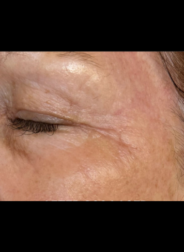 Close-up after-treatment photo showing smoother, firmer skin around the eye area with noticeably reduced wrinkles and improved texture following CO2 laser treatment.