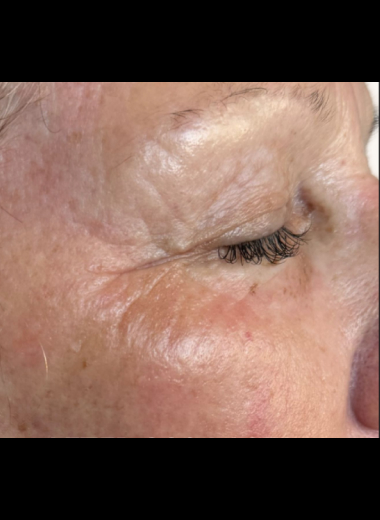 Close-up after photo showing smoother skin around the eye area with reduced fine lines and wrinkles following CO2 laser treatment.