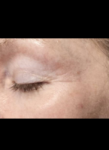 Patient case study result after CO2 laser resurfacing, demonstrating refined skin texture, tighter periorbital tissue, and reduced fine lines.