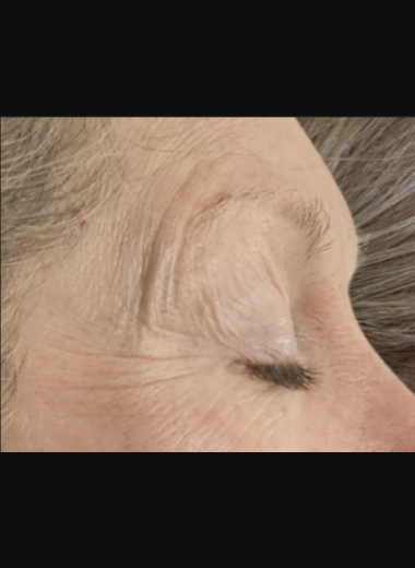 Pre-procedure close-up of periorbital rhytids, fine lines, and dermatochalasis around the eyelid and periocular skin prior to fractional CO2 laser therapy.