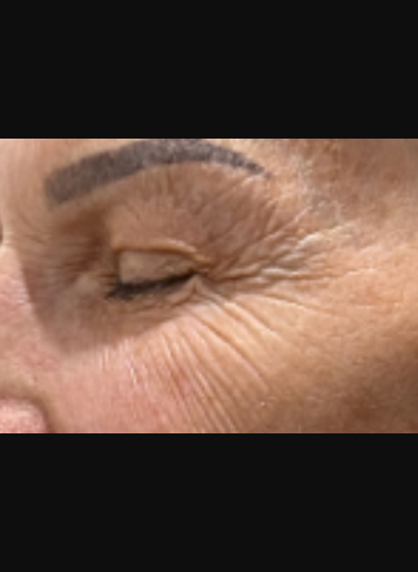Before CO2 laser treatment showing fine lines around the eye area.